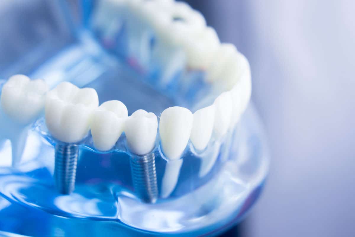 Dental Implants